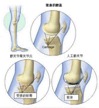 26项临床实验证明，间充质干细胞治疗膝骨关节炎有效，其疗法已经成功上市