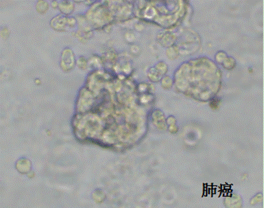 医学药筛新变革｜世界首例由实体瘤癌症患者为来源的类器官，成功筛选到临床候选药物！
